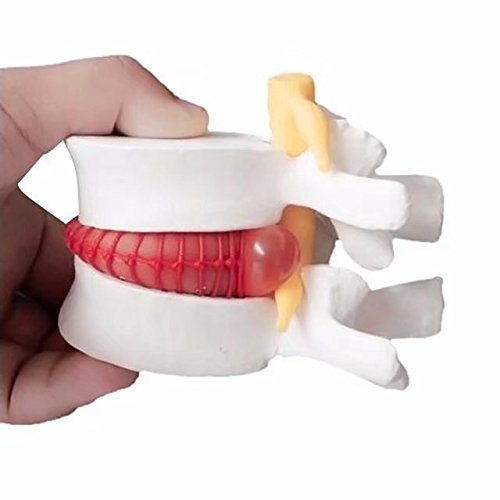 lumbar disc herniation spine anatomical model