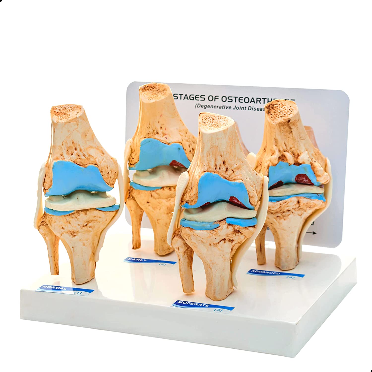arthritis knee anatomy model