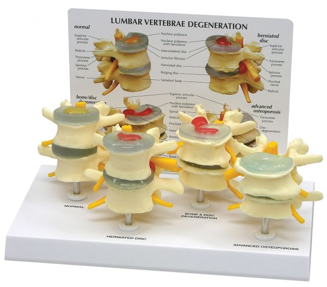 lumbar vertebrae degeneration anatomical model