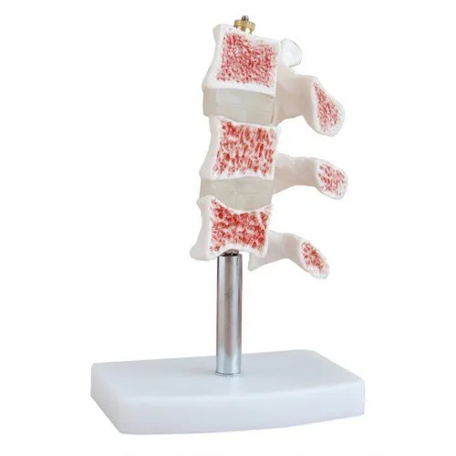 vertebral osteoporosis anatomical model