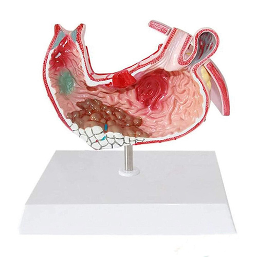 diseased stomach anatomical model